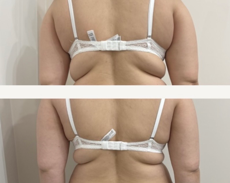 HIFU DORSAL SUPERIOR (pliu sub linia sutienului)